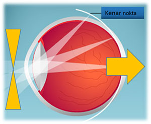 Resim 6: Gözlük kullananlarda göz küresinin geriye doğru büyümesi ve miyopinin artmaya devam etmesi.