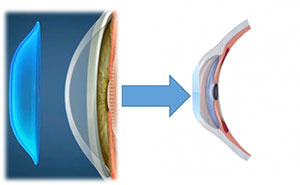 Resim 8: Korneaya yaslanarak geçici düzleşme oluşturan ortokeratoloji lensi .