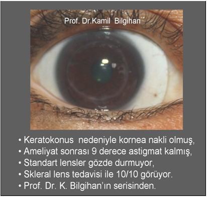 Keratokonus nedeniyle kornea nakli olmuş, ameliyat sonrası 9 derece astigmat kalmış, standart lensler gözde durmuyor, skleral lens tedavisiyle 10/10 görüyor.