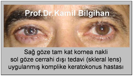 Sağ göze tam kat kornea nakli, sol göze cerrahi dışı tedavi(skleral lens) uygulanmış komplike keratokonus hastası
